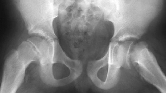 Obesity, low vitamin D behind surge in rare childhood hip joint disorders