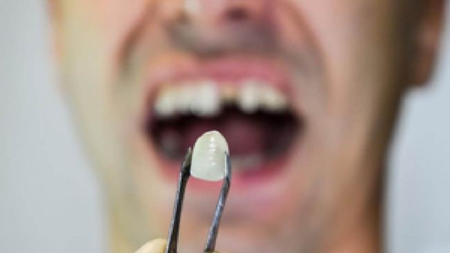 New Technique To Replace Lost Teeth: Experts