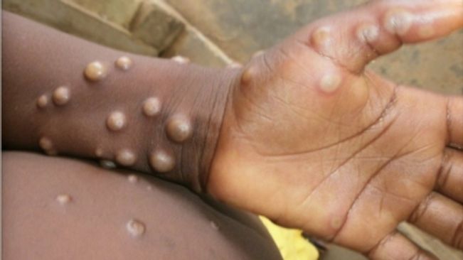 Monkeyx: Europe's red alert for monkeypox as nations told to prepare vaccination strategies
