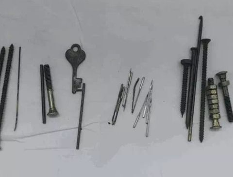 Nails, needles, nuts and bolts removed from man's stomach in Jaipur