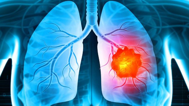 Why are most lung cancer patients in India non-smokers?