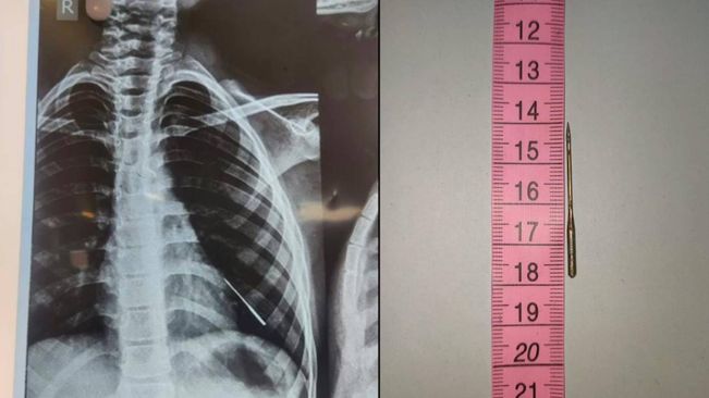 AIIMS Bhubaneswar Doctors Extract Sewing Needle From 9-Year-Old's Lung