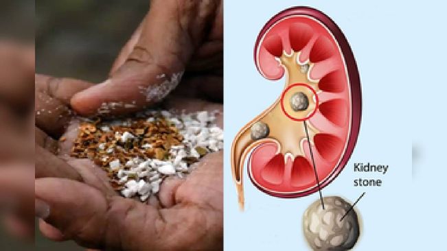 Pan Masala Can Cause Larger Kidney Stones: Experts