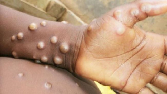 Mpox Kills Over 570 In DR Congo: Health Minister