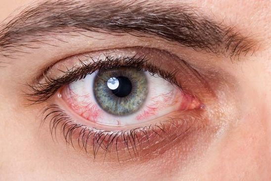 Why Are Eyes Red?