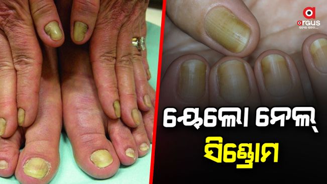 yellow-nail-syndrome-disease